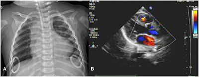 Case report: Right coronary artery rupture—A rare complication of cardiopulmonary resuscitation